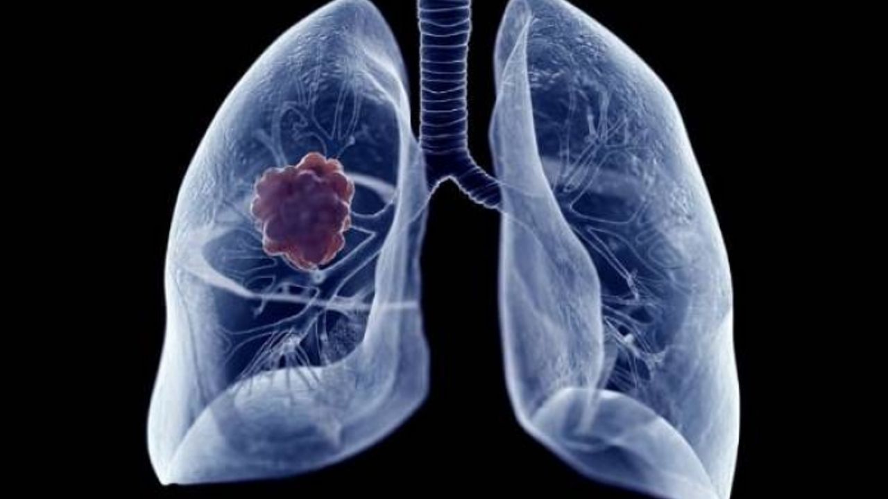 Akciğer kanseri nedir, nasıl teşhis edilir?