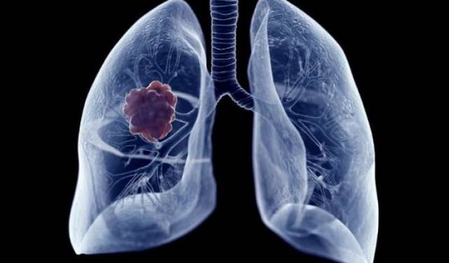 Akciğer kanseri nedir, nasıl teşhis edilir?